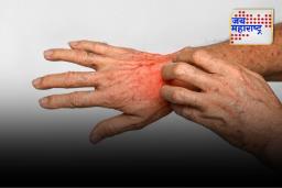 Fungal Infection: फंगल इंफेक्शन का होते आणि त्याची कारणे काय?